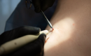 Laser vs. chirurgické odstranění bradavic. Která metoda je rychlejší, šetrnější a účinnější? obrázek 14 Laser vs. chirurgické odstranění bradavic. Která metoda je rychlejší, šetrnější a účinnější? obrázek 13