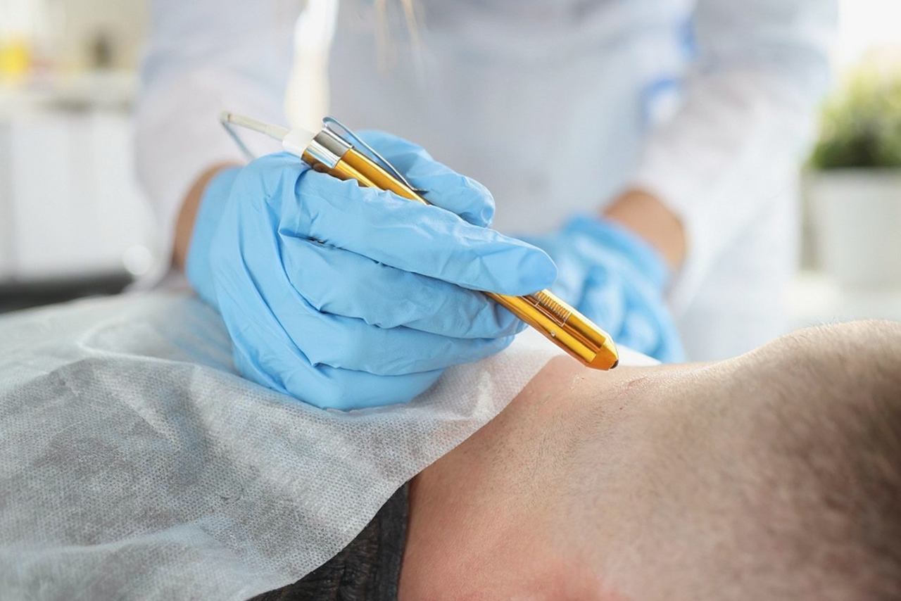 photo (5) Jak odstranit malé bradavičky na krku? Průvodce domácími metodami i klinickými zákroky obrázek 4