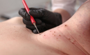 Jak odstranit malé bradavičky na krku? Průvodce domácími metodami i klinickými zákroky obrázek 19 Jak odstranit malé bradavičky na krku? Průvodce domácími metodami i klinickými zákroky obrázek 18
