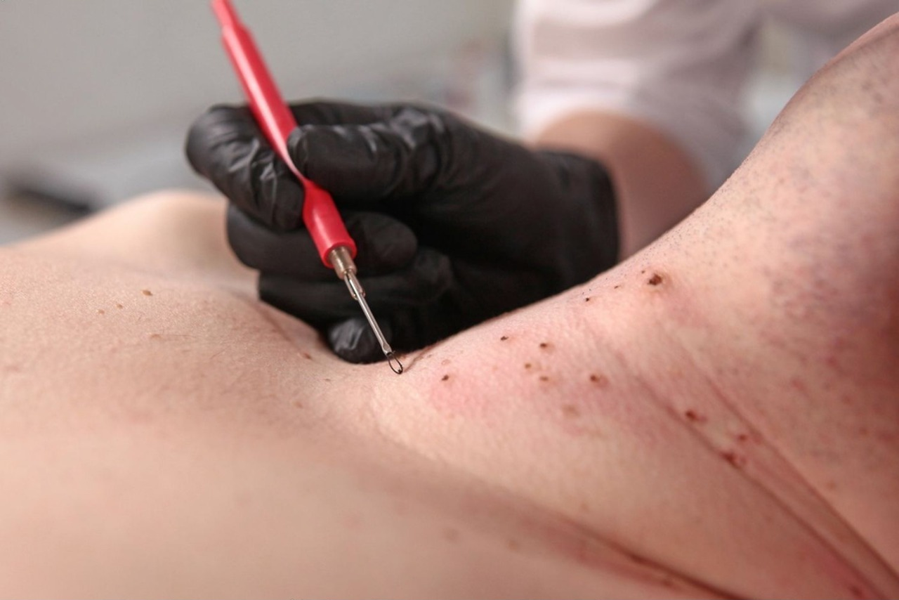 Jak odstranit malé bradavičky na krku? Průvodce domácími metodami i klinickými zákroky obrázek 1